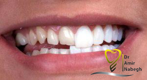 روکش دندان (dental crown)